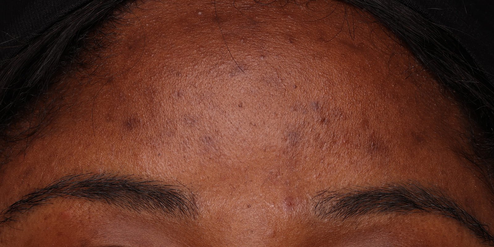 Close-up of woman's skin before using USRx HyperCorrect Treatment