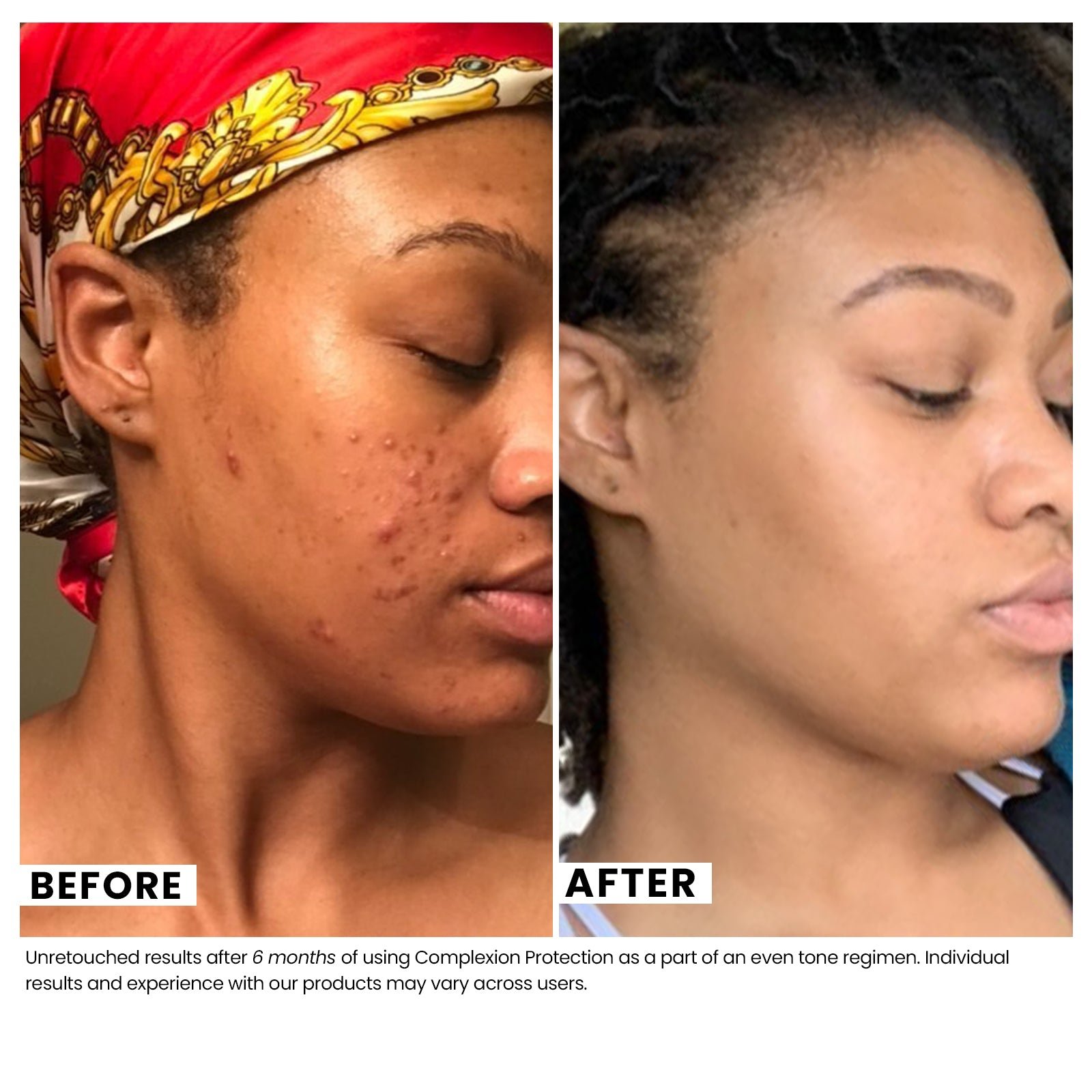 Woman's skin before and after using USRx Complexion Protection SPF30 Moisturizer with visibly improved skin