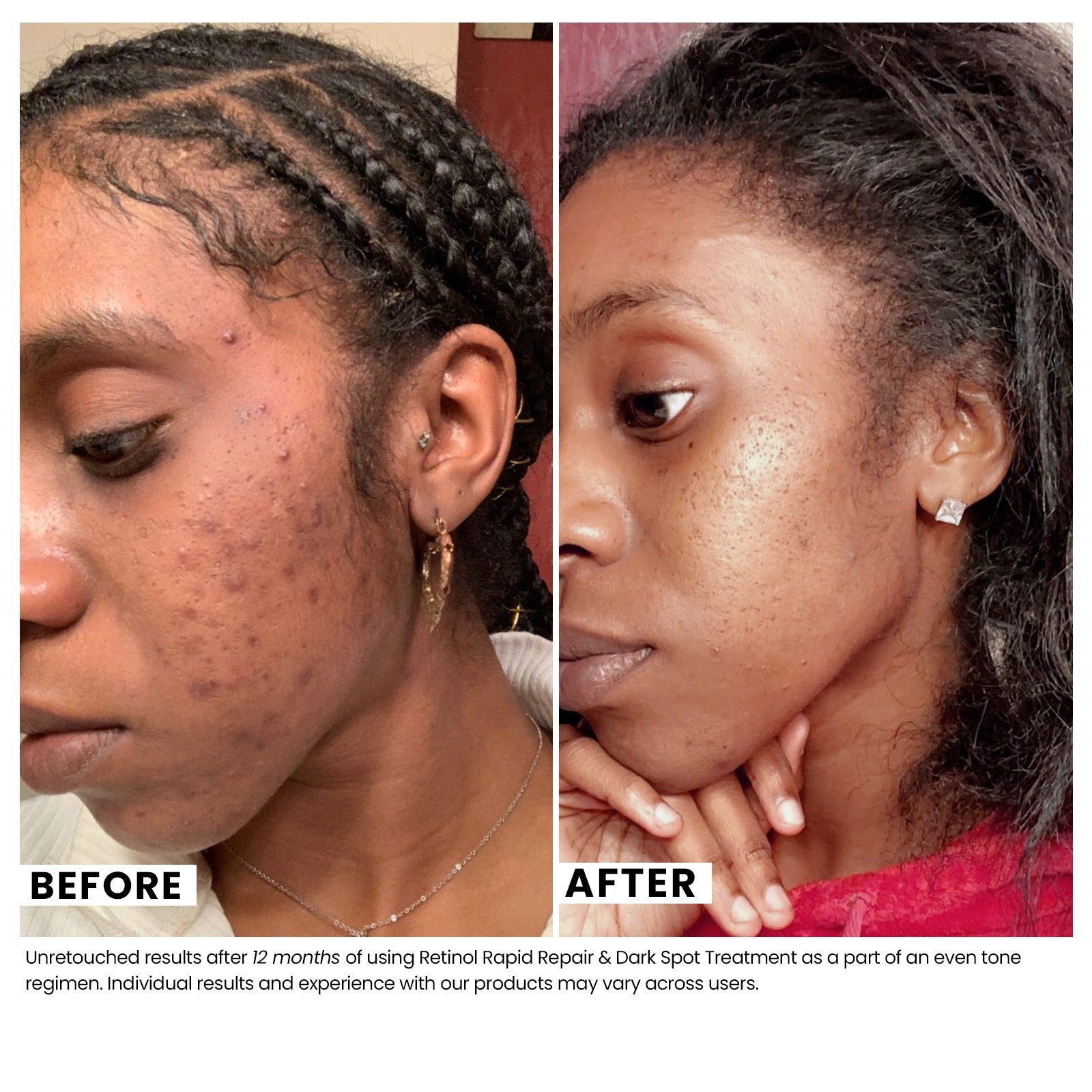 Woman's skin before and after using USRx Retinol Rapid Repair & Dark Spot Treatment with visibly improved skin